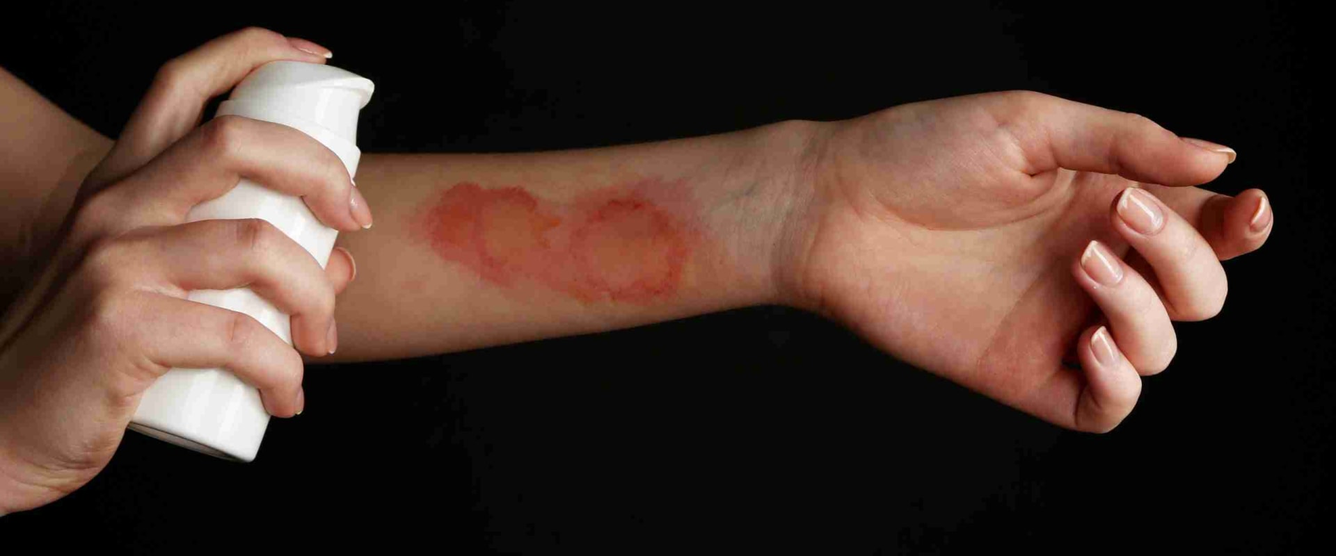 Recognize the Signs: 1st vs 2nd vs 3rd Degree Burns and When to Seek Help