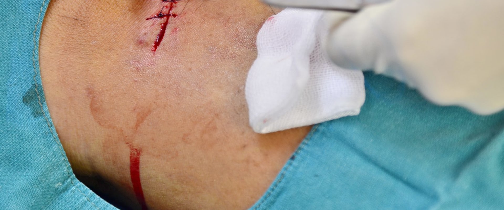 Complete Timeline on How Long It Takes for Stitches to Heal After Surgery Including Healing Phases, Care Tips