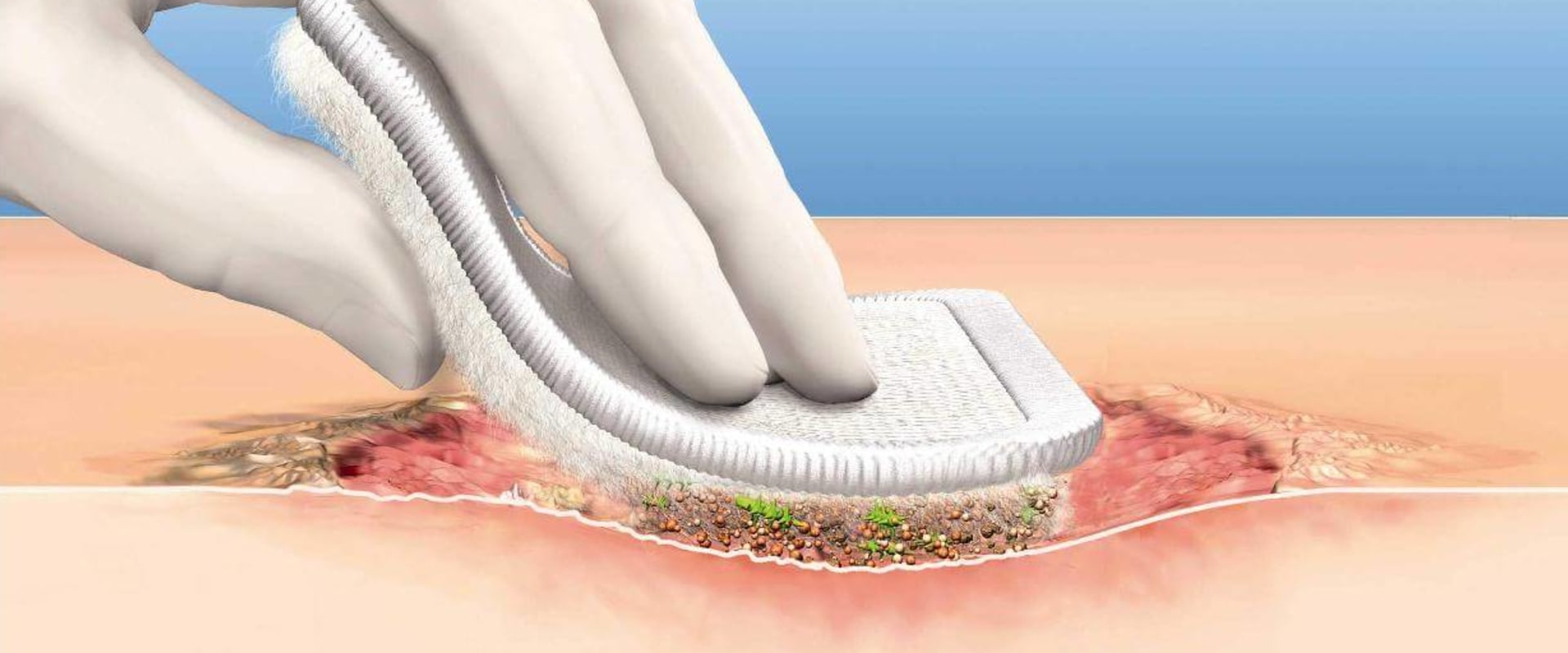 The Crucial Role of Debridement in Wound Healing