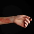 Recognize the Signs: 1st vs 2nd vs 3rd Degree Burns and When to Seek Help