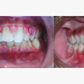 The Benefits of Anesthesia in Debridement Procedures