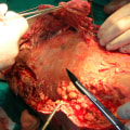 The Role of Debridement in Wound Healing