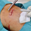 Complete Timeline on How Long It Takes for Stitches to Heal After Surgery Including Healing Phases, Care Tips