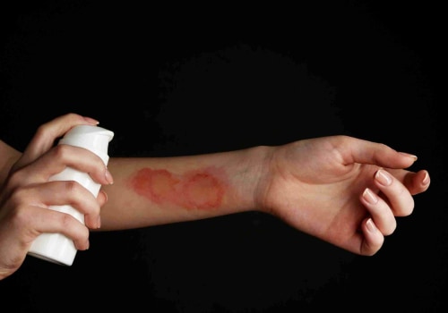 Recognize the Signs: 1st vs 2nd vs 3rd Degree Burns and When to Seek Help