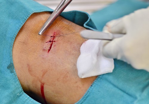 Complete Timeline on How Long It Takes for Stitches to Heal After Surgery Including Healing Phases, Care Tips